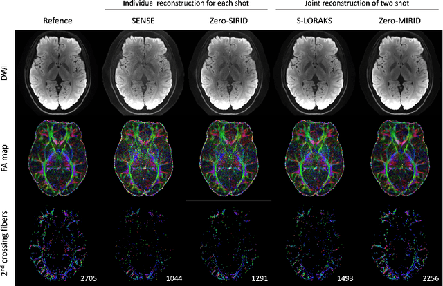 Figure 4 for Improved Multi-Shot Diffusion-Weighted MRI with Zero-Shot Self-Supervised Learning Reconstruction