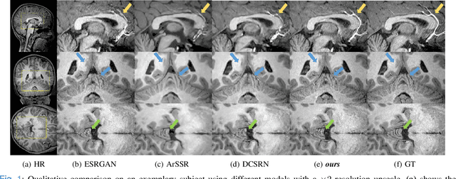 Figure 1 for A Three-Player GAN for Super-Resolution in Magnetic Resonance Imaging