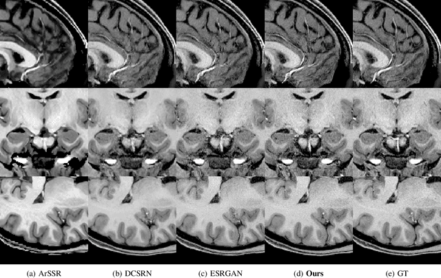 Figure 4 for A Three-Player GAN for Super-Resolution in Magnetic Resonance Imaging