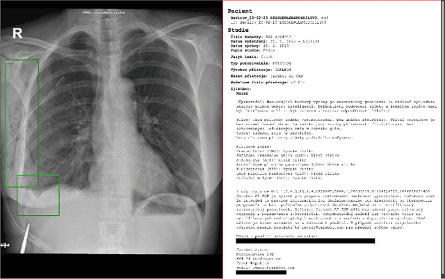 Figure 2 for Can Deep Learning Reliably Recognize Abnormality Patterns on Chest X-rays? A Multi-Reader Study Examining One Month of AI Implementation in Everyday Radiology Clinical Practice
