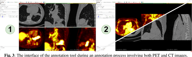 Figure 3 for Multimodal Interactive Lung Lesion Segmentation: A Framework for Annotating PET/CT Images based on Physiological and Anatomical Cues
