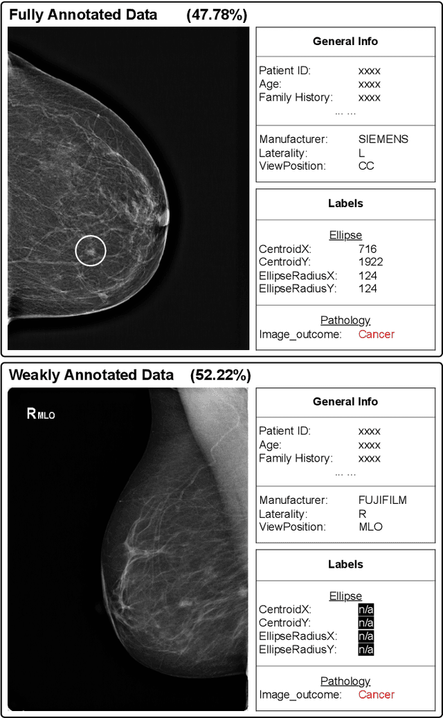 Figure 1 for BRAIxDet: Learning to Detect Malignant Breast Lesion with Incomplete Annotations