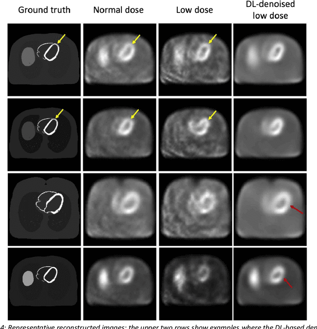 Figure 3 for Need for Objective Task-based Evaluation of Deep Learning-Based Denoising Methods: A Study in the Context of Myocardial Perfusion SPECT