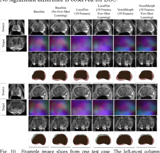 Figure 2 for Meta-Learning Initializations for Interactive Medical Image Registration