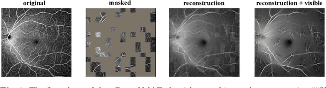 Figure 2 for Semi-Supervised Semantic Segmentation Methods for UW-OCTA Diabetic Retinopathy Grade Assessment