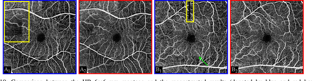 Figure 2 for Reference-based OCT Angiogram Super-resolution with Learnable Texture Generation