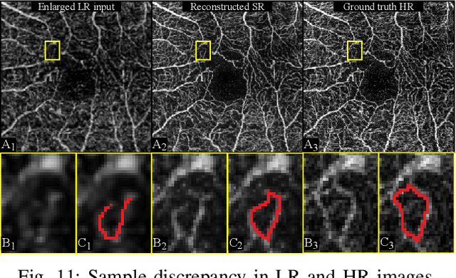 Figure 3 for Reference-based OCT Angiogram Super-resolution with Learnable Texture Generation
