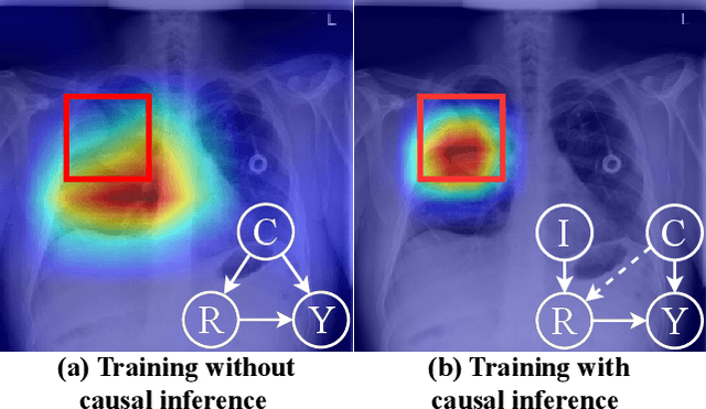 Figure 1 for Instrumental Variable Learning for Chest X-ray Classification