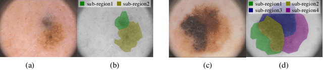 Figure 1 for Unsupervised Skin Lesion Segmentation via Structural Entropy Minimization on Multi-Scale Superpixel Graphs