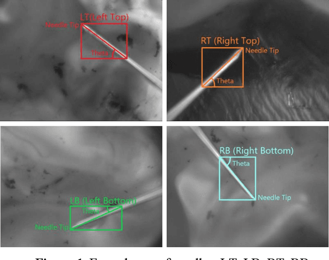 Figure 1 for The Neural Networks Based Needle Detection for Medical Retinal Surgery