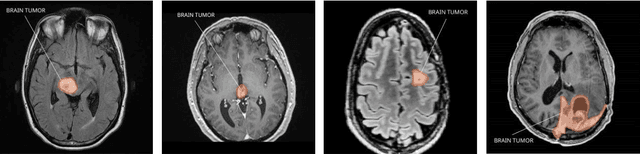 Figure 4 for A deep learning approach for brain tumor detection using magnetic resonance imaging