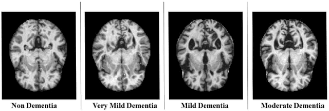 Figure 2 for Detection of Alzheimer's Disease using MRI scans based on Inertia Tensor and Machine Learning