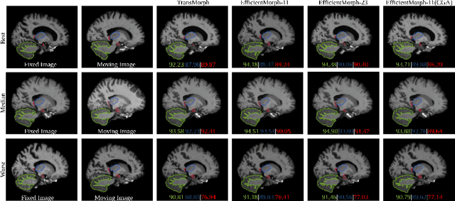 Figure 4 for EfficientMorph: Parameter-Efficient Transformer-Based Architecture for 3D Image Registration