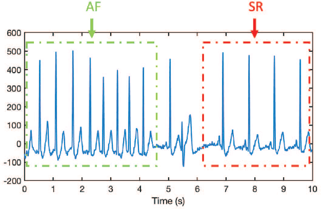 Figure 4 for A Singular-value-based Marker for the Detection of Atrial Fibrillation Using High-resolution Electrograms and Multi-lead ECG