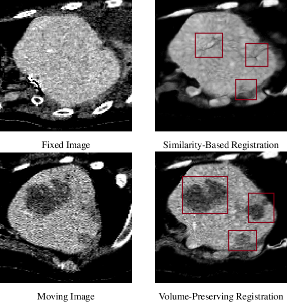 Figure 1 for Preserving Tumor Volumes for Unsupervised Medical Image Registration