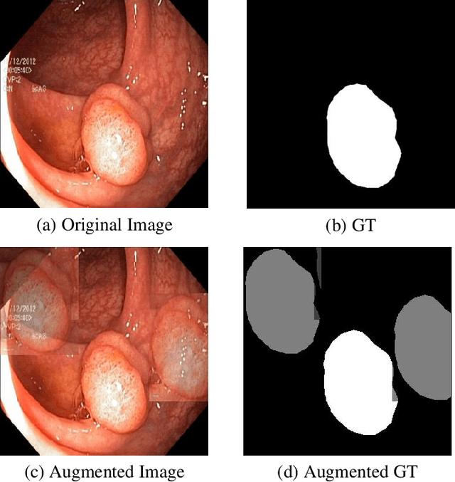 Figure 1 for Spatially Exclusive Pasting: A General Data Augmentation for the Polyp Segmentation