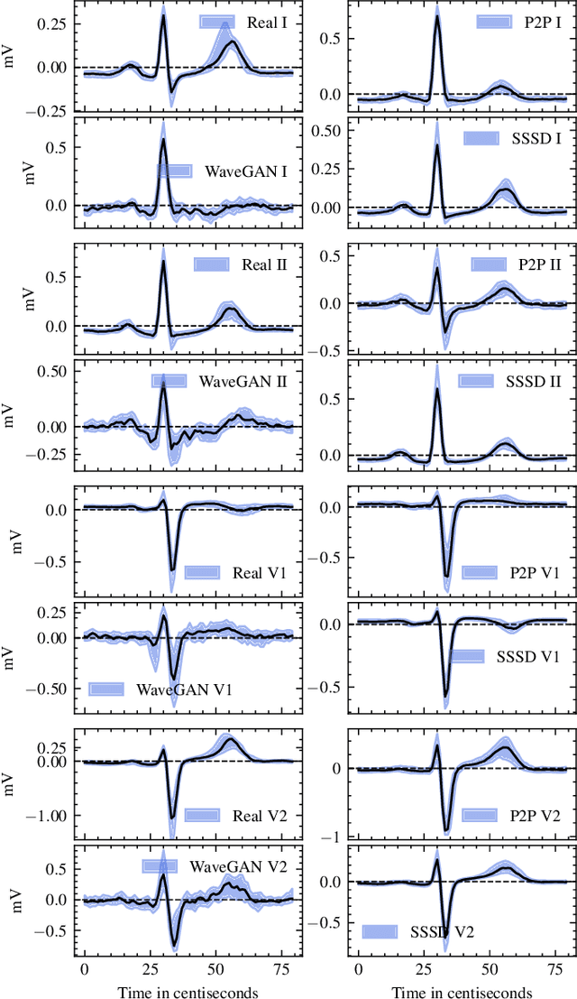 Figure 1 for Diffusion-based Conditional ECG Generation with Structured State Space Models