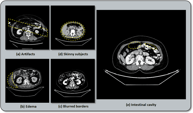 Figure 4 for AATCT-IDS: A Benchmark Abdominal Adipose Tissue CT Image Dataset for Image Denoising, Semantic Segmentation, and Radiomics Evaluation