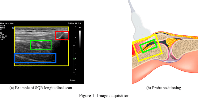 Figure 1 for Ultrasound Detection of Subquadricipital Recess Distension