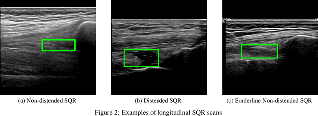 Figure 3 for Ultrasound Detection of Subquadricipital Recess Distension