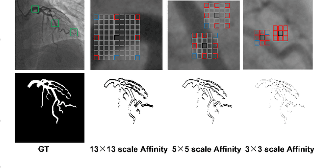 Figure 3 for Affinity Feature Strengthening for Accurate, Complete and Robust Vessel Segmentation