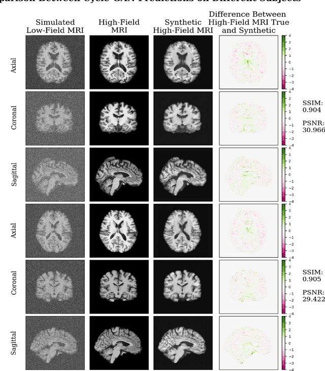 Figure 2 for Denoising Simulated Low-Field MRI (70mT) using Denoising Autoencoders (DAE) and Cycle-Consistent Generative Adversarial Networks (Cycle-GAN)