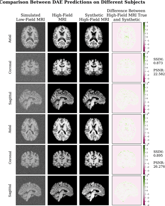 Figure 3 for Denoising Simulated Low-Field MRI (70mT) using Denoising Autoencoders (DAE) and Cycle-Consistent Generative Adversarial Networks (Cycle-GAN)