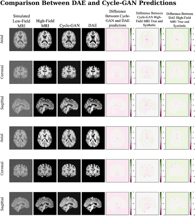 Figure 4 for Denoising Simulated Low-Field MRI (70mT) using Denoising Autoencoders (DAE) and Cycle-Consistent Generative Adversarial Networks (Cycle-GAN)