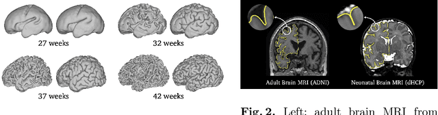 Figure 1 for Conditional Temporal Attention Networks for Neonatal Cortical Surface Reconstruction