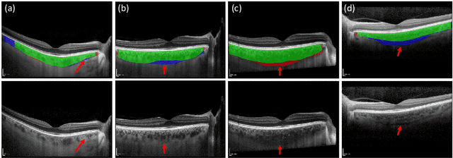Figure 4 for Efficient and fully-automatic retinal choroid segmentation in OCT through DL-based distillation of a hand-crafted pipeline