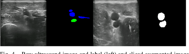 Figure 4 for Reslicing Ultrasound Images for Data Augmentation and Vessel Reconstruction