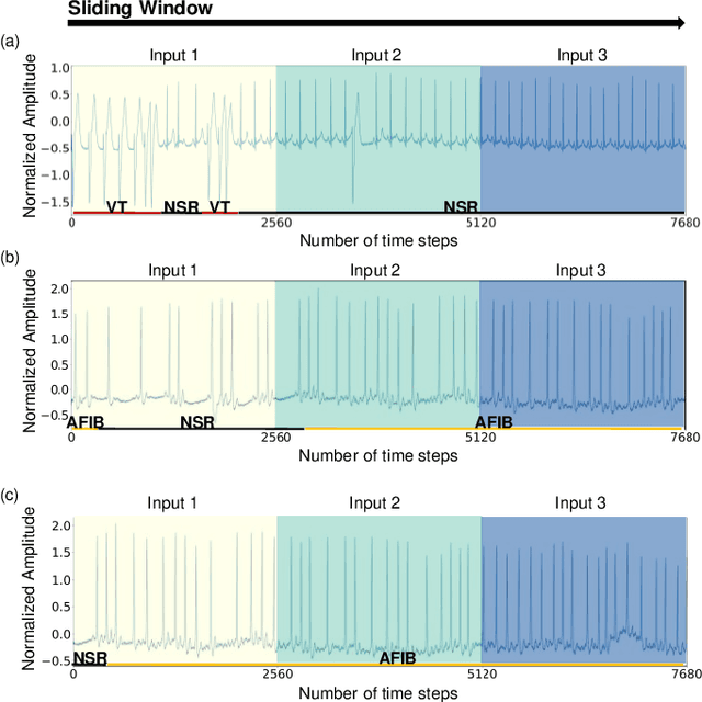 Figure 1 for Local-Global Temporal Fusion Network with an Attention Mechanism for Multiple and Multiclass Arrhythmia Classification