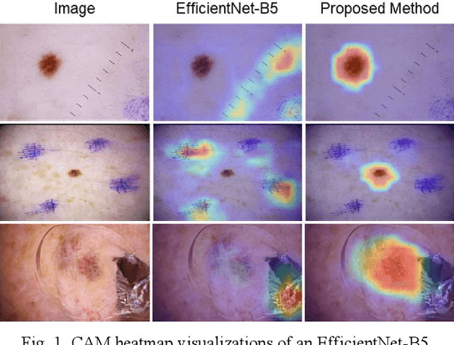 Figure 1 for Increasing Melanoma Diagnostic Confidence: Forcing the Convolutional Network to Learn from the Lesion