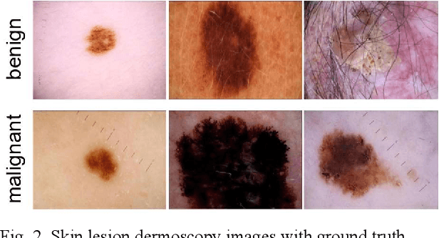 Figure 2 for Increasing Melanoma Diagnostic Confidence: Forcing the Convolutional Network to Learn from the Lesion