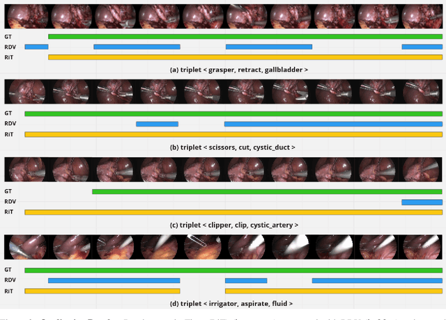 Figure 4 for Rendezvous in Time: An Attention-based Temporal Fusion approach for Surgical Triplet Recognition