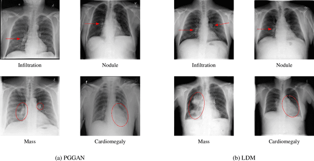 Figure 3 for Generation of Anonymous Chest Radiographs Using Latent Diffusion Models for Training Thoracic Abnormality Classification Systems
