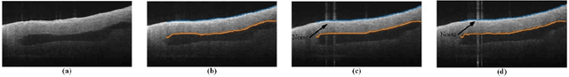 Figure 1 for Opto-UNet: Optimized UNet for Segmentation of Varicose Veins in Optical Coherence Tomography