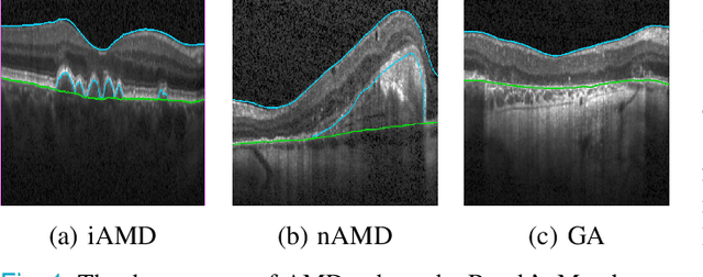 Figure 1 for Segmentation of Bruch's Membrane in retinal OCT with AMD using anatomical priors and uncertainty quantification