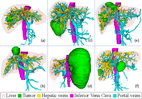 Figure 3 for Towards Simultaneous Segmentation of Liver Tumors and Intrahepatic Vessels via Cross-attention Mechanism