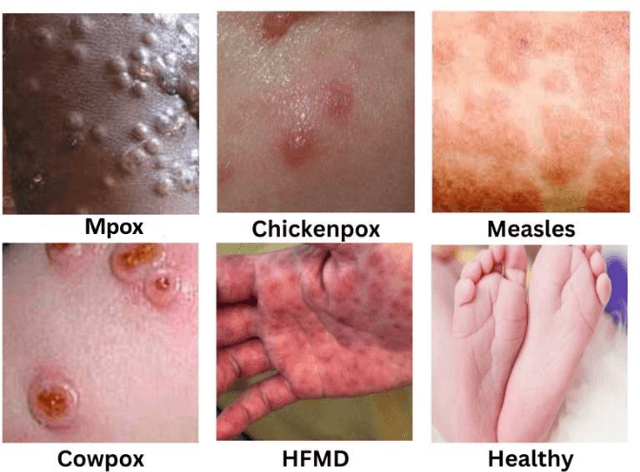 Figure 4 for A Web-based Mpox Skin Lesion Detection System Using State-of-the-art Deep Learning Models Considering Racial Diversity