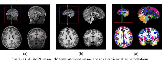 Figure 3 for Age-Stratified Differences in Morphological Connectivity Patterns in ASD: An sMRI and Machine Learning Approach