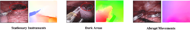 Figure 1 for Rethinking Low-quality Optical Flow in Unsupervised Surgical Instrument Segmentation