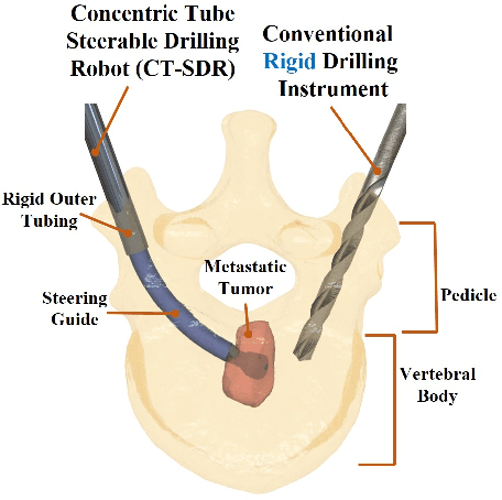 Figure 1 for A Novel Concentric Tube Steerable Drilling Robot for Minimally Invasive Treatment of Spinal Tumors Using Cavity and U-shape Drilling Techniques