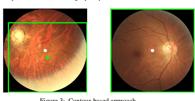 Figure 3 for AMDNet23: A combined deep Contour-based Convolutional Neural Network and Long Short Term Memory system to diagnose Age-related Macular Degeneration