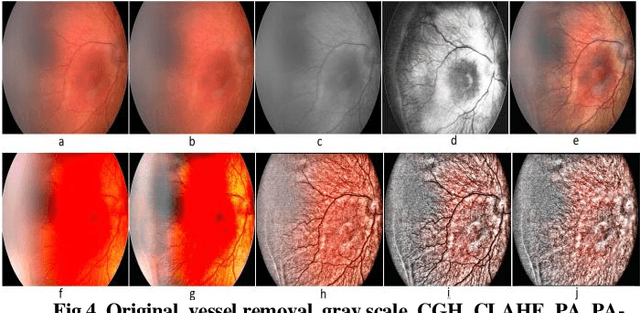 Figure 4 for Novel Fundus Image Preprocessing for Retcam Images to Improve Deep Learning Classification of Retinopathy of Prematurity