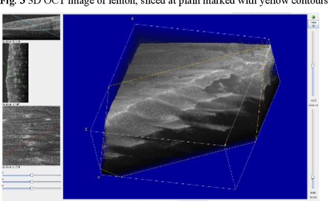 Figure 3 for Modified watershed approach for segmentation of complex optical coherence tomographic images