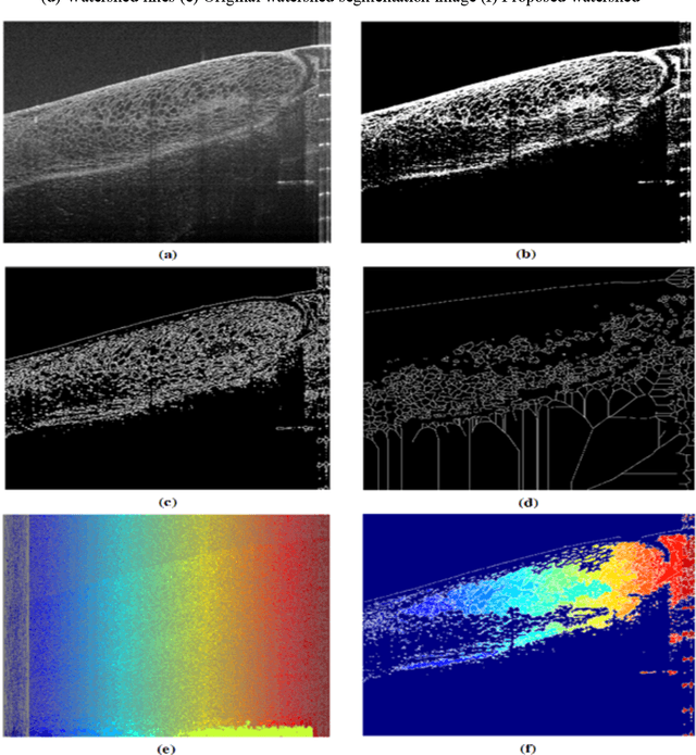 Figure 4 for Modified watershed approach for segmentation of complex optical coherence tomographic images
