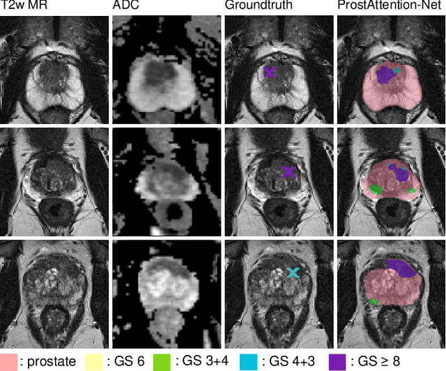 Figure 3 for ProstAttention-Net: A deep attention model for prostate cancer segmentation by aggressiveness in MRI scans