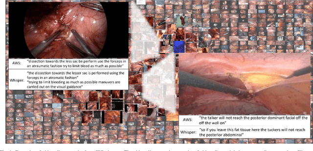 Figure 1 for Learning Multi-modal Representations by Watching Hundreds of Surgical Video Lectures
