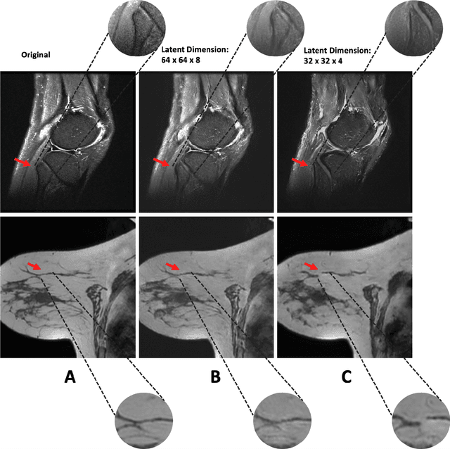 Figure 4 for Medical Diffusion -- Denoising Diffusion Probabilistic Models for 3D Medical Image Generation